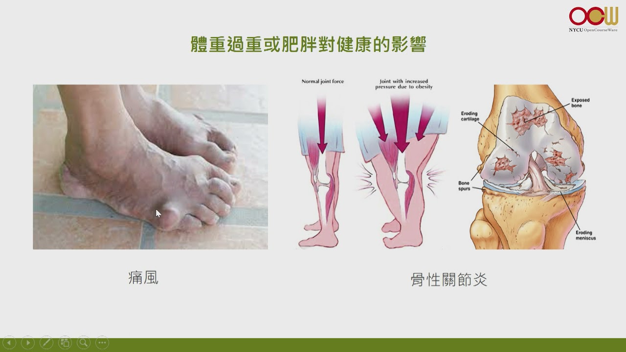 代謝症候群之病態型